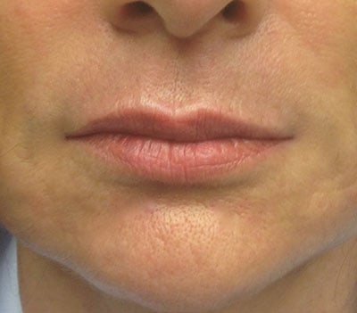 lips after