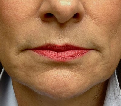 lips before