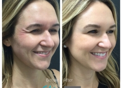 Botox