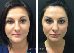 Cheek Filler