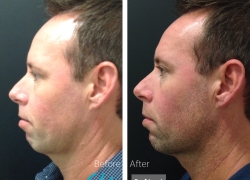 Chin Filler