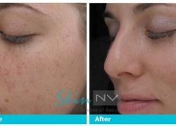 After Peels and IPL