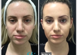 Cheek FIller