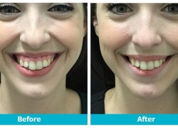 botox gummy smile