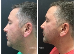 Kybella