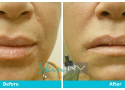 Smile Lines – Radiesse