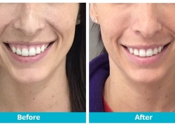 botox gummy smile