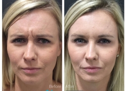 Botox