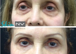 Under Eye Filler