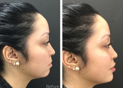 Chin Filler