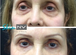 Under Eye Filler