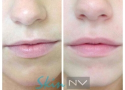Lip Filler