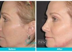 Radiesse Jaw Rejuvination