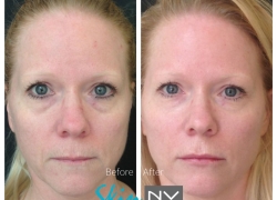 Under Eye Filler & Lip Filler