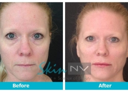 Under Eye Filler and Lip Filler