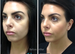 Cheek Filler