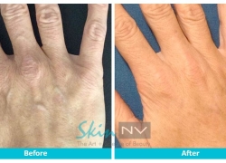 Radiesse Hands
