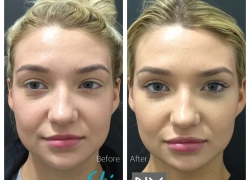 Lip Filler