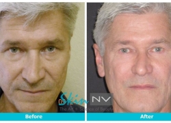 Filler, Botox and Blepharoplasty