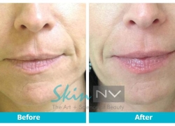 Lip Filler