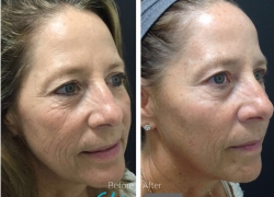 Cheek Filler