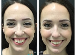 Botox for Gummy Smile
