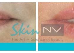Lip Filler