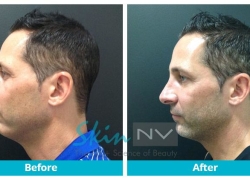 Chin Filler
