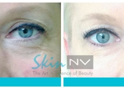 Filler Under the Eyes