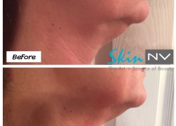 Kybella
