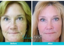 Botox and Filler