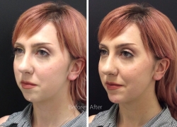 Chin Filler