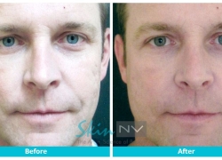 Filler for Acne Scars