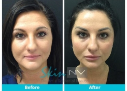 Botox & Filler