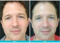 Bio Facial (with serum)