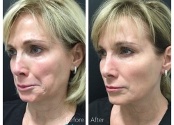 Botox