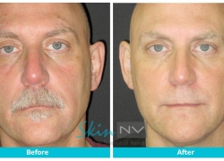 IPL and Filler