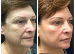 Liquid Facelist