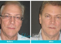 Botox and Filler