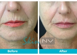Lip Filler
