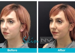 Chin Filler