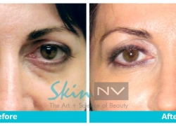 Filler Under Eyes