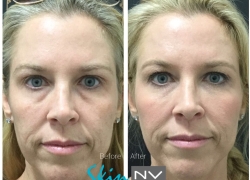 Under Eye Filler