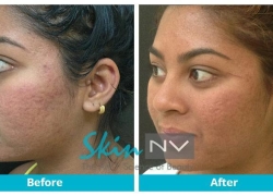 PRP for acne scars