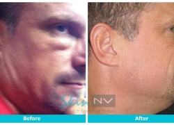Corrective procedure