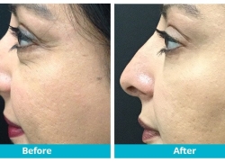 volbella nose