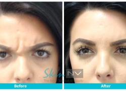 Botox Forehead