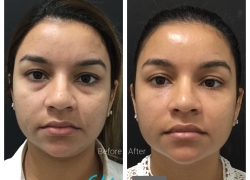 Under Eye Filler
