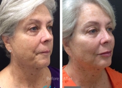 Cheek Filler