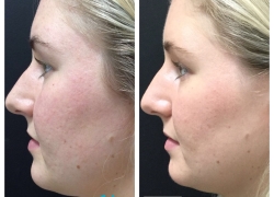 IPL & Biofacial